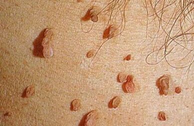 Cómo se manifiesta el virus del papiloma humano