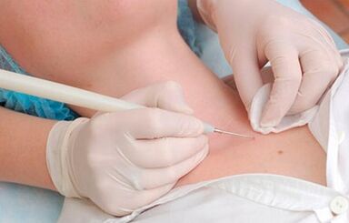 Las causas del virus del papiloma humano
