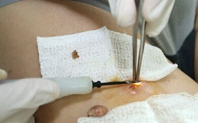 Tratamiento quirúrgico del virus del papiloma humano