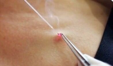 Eliminación de papiloma en el cuerpo con un láser