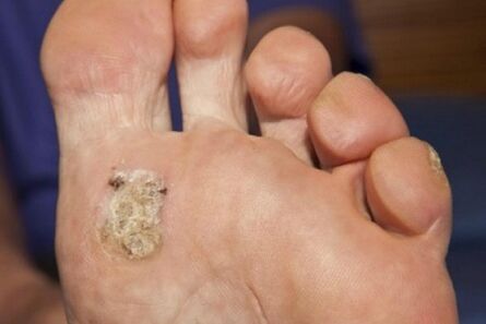 Las razones de la aparición de una verruga plantar