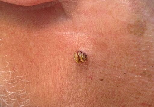 Papiloma en el cuello