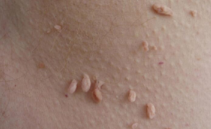 Razones de la aparición de papilomas en el cuerpo humano.