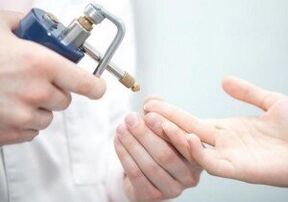 métodos modernos para eliminar papilomas.