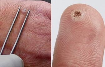 síntomas de papilomas en el cuerpo humano