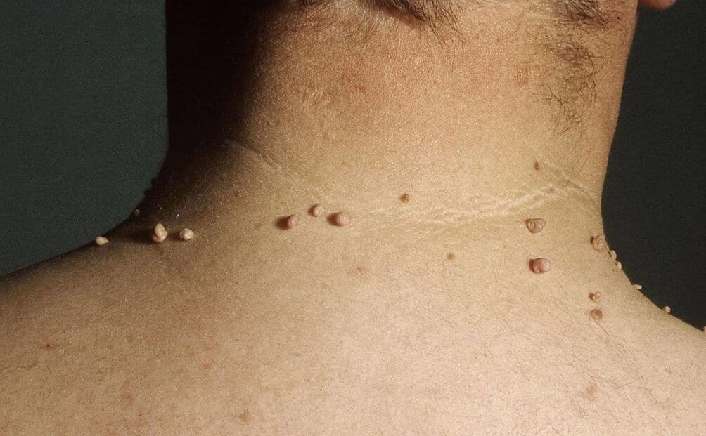 causas de papilomas en el cuello