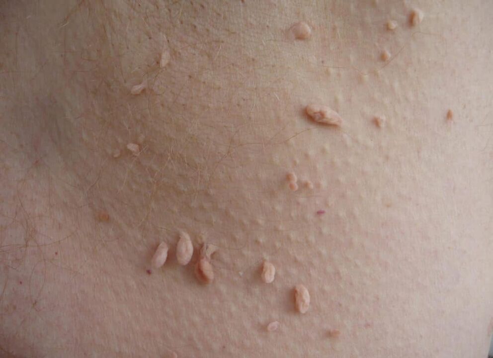 tipos de papilomas en el cuello