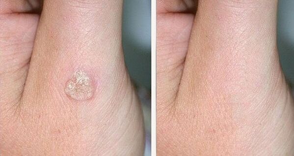 Fotos antes y después de la eliminación de las verrugas con remedios naturales.