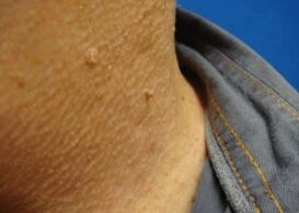 papilomas filamentosos en el cuello