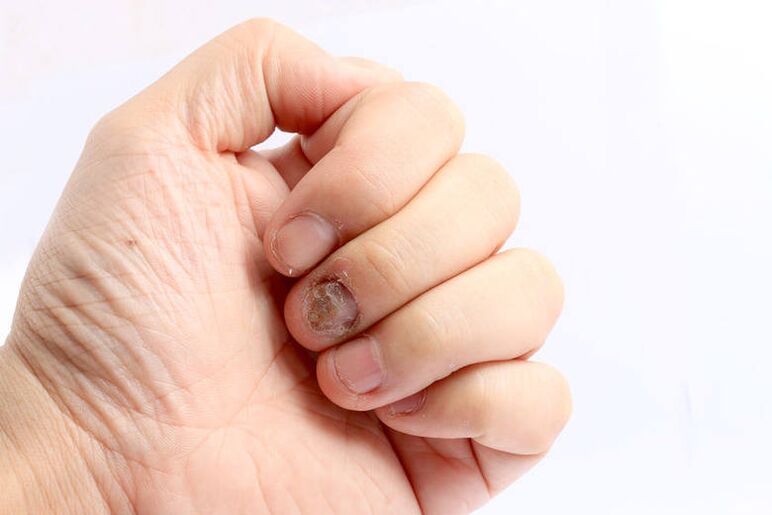 indicación de uso Keramin - hongos en las uñas